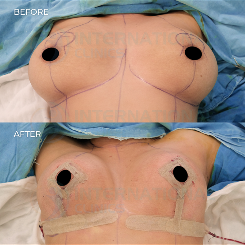 Breast Lift Before and After image